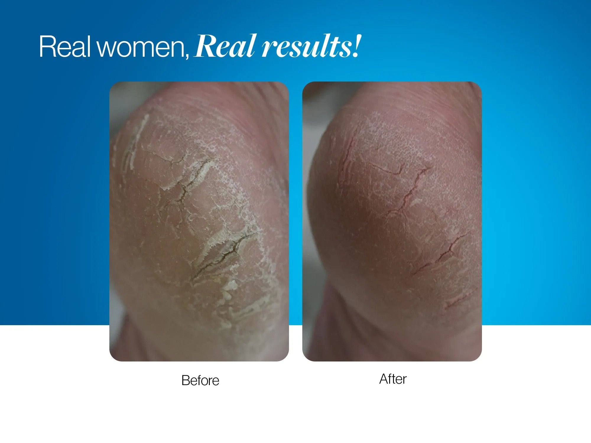 20% Urea Foot Roll On - 50 ml